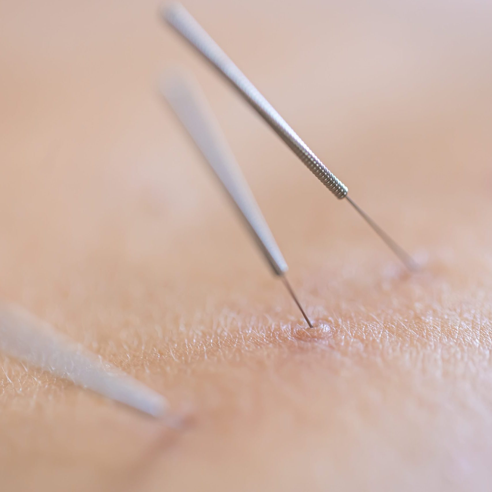 Dry Needling kinesitherapie sofie deprez avelgem revalab