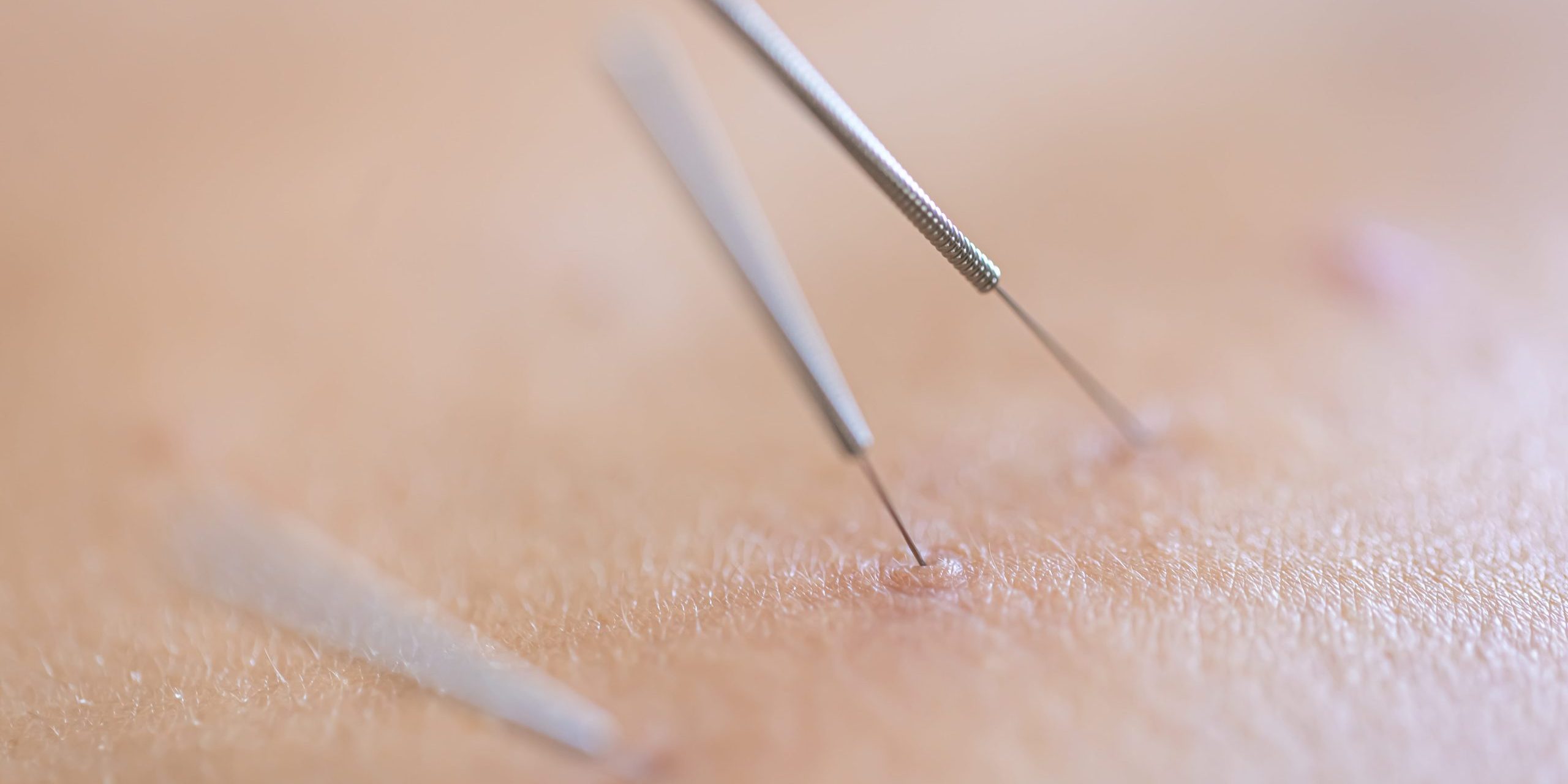 Dry Needling kinesitherapie sofie deprez avelgem revalab Dry Needling kinesitherapie sofie deprez avelgem revalab